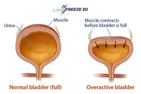 diagram of overactive bladder treatment Loughborough