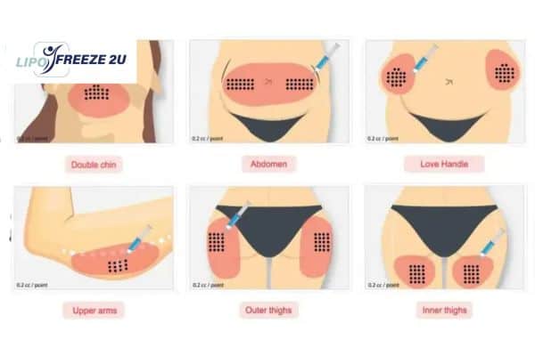 Benefits of Choosing Aqualyx for Fat Reduction Loughborough