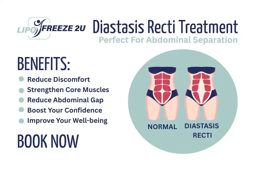 Benefits of body toning treatment Loughborough for Diastasis recti