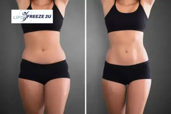 How Can LIPO FREEZE 2U Support Your Post-Pregnancy Body Recovery Loughborough?