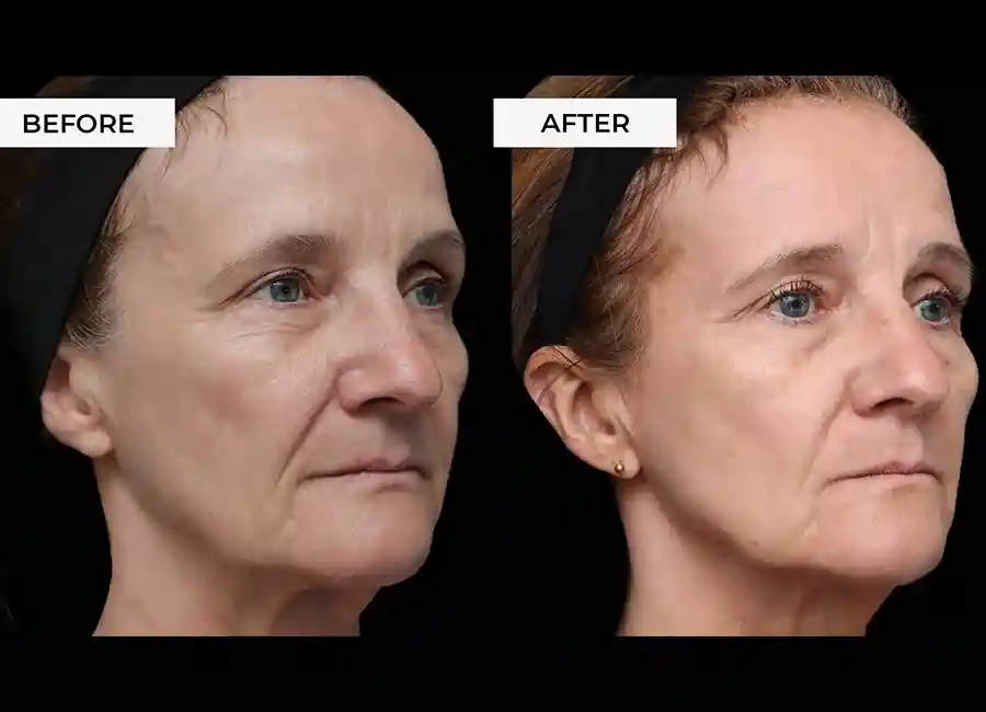 How Many RF Microneedling Sessions Will You Need to See a Difference Loughborough?