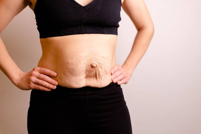 Is Surgery Really the Only Way to Repair Diastasis Recti Loughborough?
