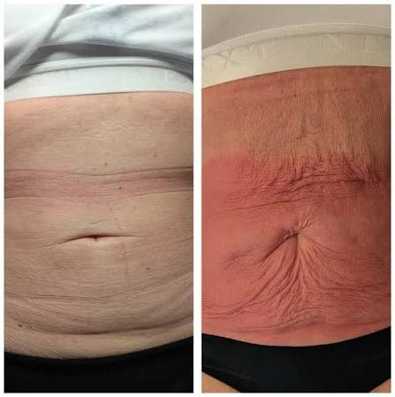 How Does RF Microneedling Improve Crepey, Thin and Uneven Skin Texture Loughborough?