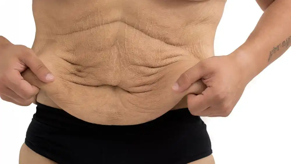 RF Microneedling for Loose Skin: How Can It Help Tighten and Reshape the Skin Loughborough?